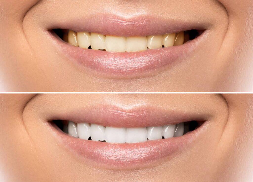 How Can You Protect Your White Smile as a Coffee Lover Scunthorpe?