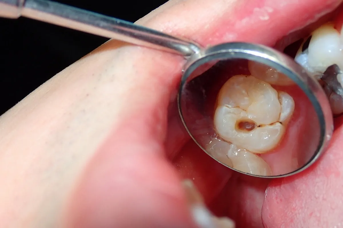 Why Do Teeth Crack? Common Causes to Know Scunthorpe