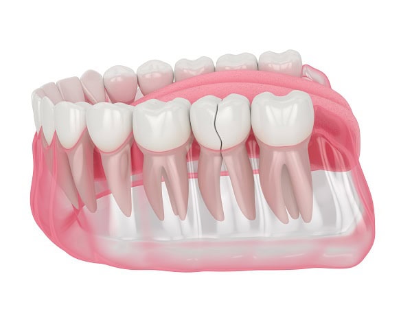 How Can You Manage Pain and Discomfort After a Root Canal Scunthorpe?
