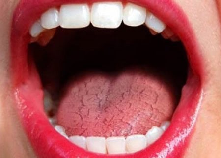 Common Causes of Dry Mouth (Xerostomia) Scunthorpe