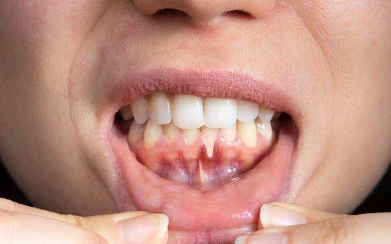 How Can Gum Disease Be Prevented Scunthorpe?