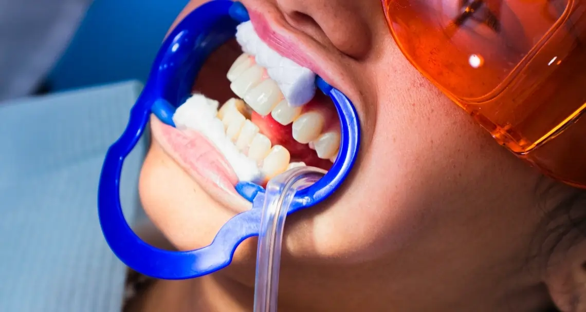 How Teeth Whitening Treatments Actually Work on Your Enamel Scunthorpe