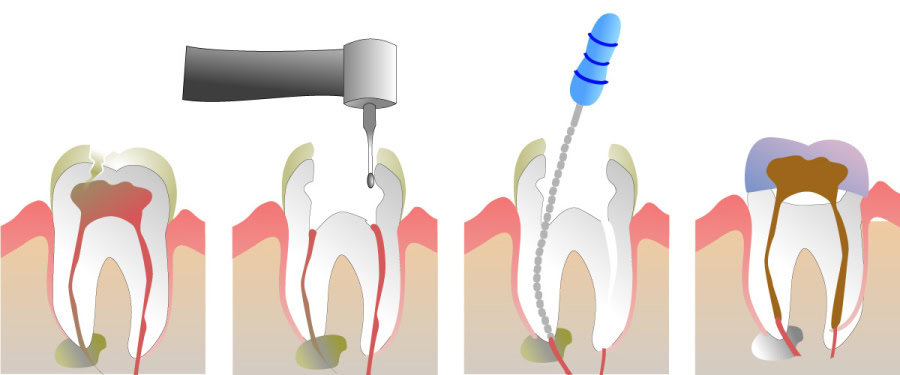 How Do You Properly Care for Your Teeth After a Root Canal Scunthorpe