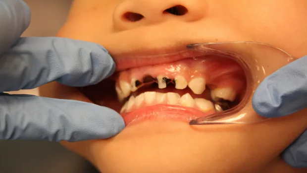 Which Foods and Drinks Cause the Most Damage to Young Smiles Scunthorpe?