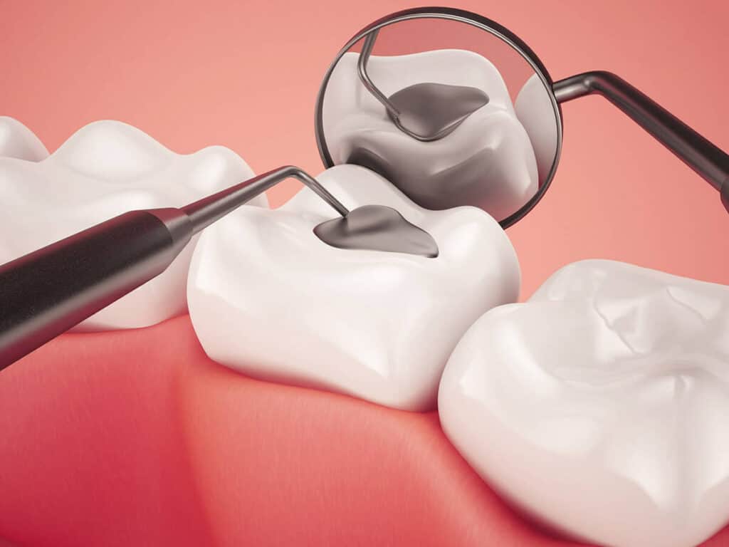 How Can You Prevent Tooth Decay Effectively Scunthorpe