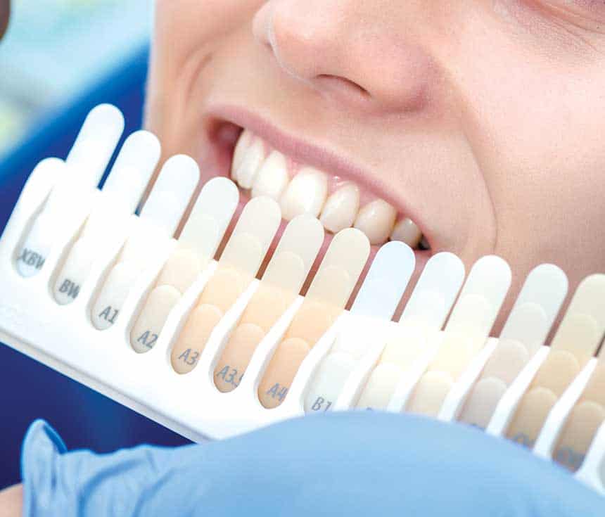 Professional vs At-Home Whitening: What You Need to Know Scunthorpe