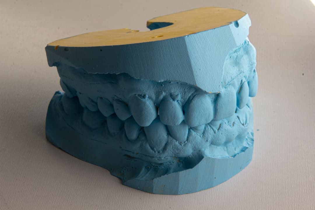 How Do Dental Implants Improve Jawbone Health and Oral Function Scunthorpe?