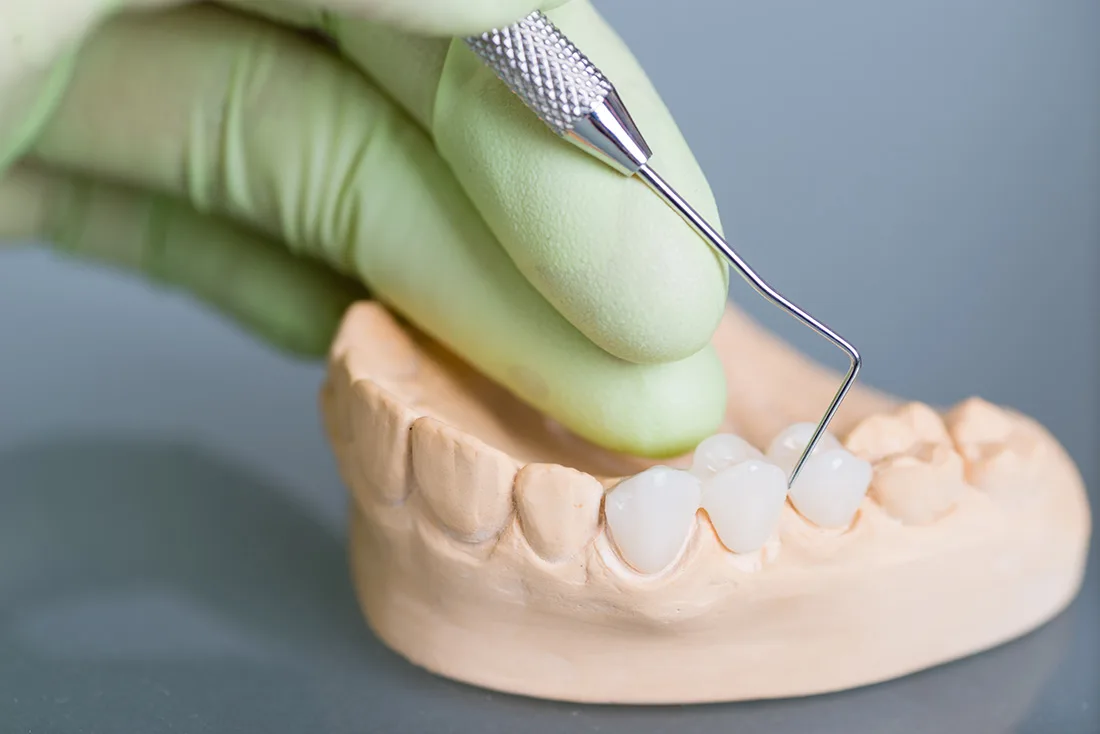 What Are the Different Types of Dental Crowns Available Scunthorpe?