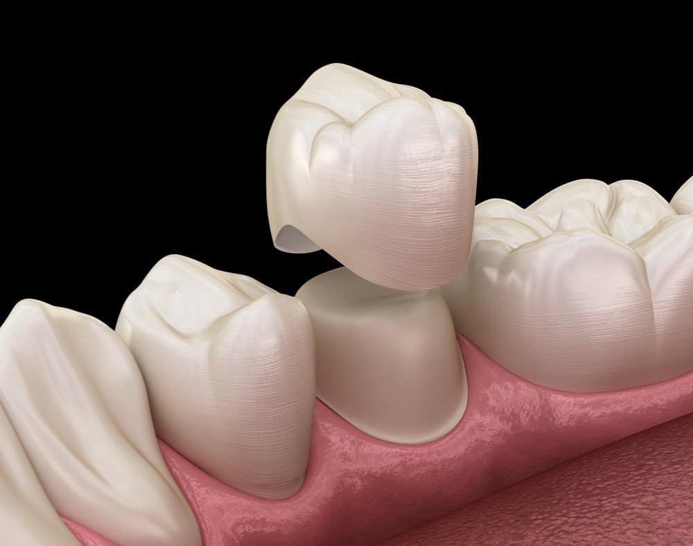 Teeth Whitening: Separating Facts from Fiction Scunthorpe
