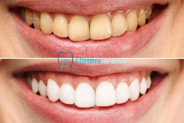 Oral Care Tips for Current and Former Smokers Scunthorpe