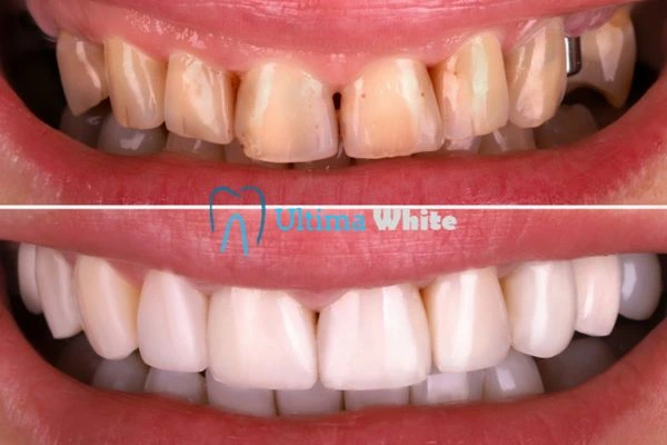 What Makes Instant Teeth Whitening Treatments So Popular Scunthorpe?