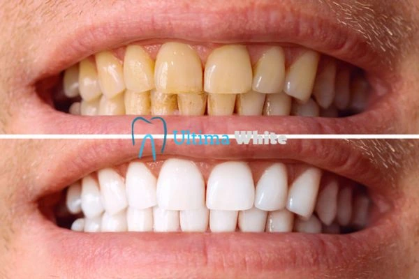 Stained Teeth and Persistent Bad Breath Scunthorpe