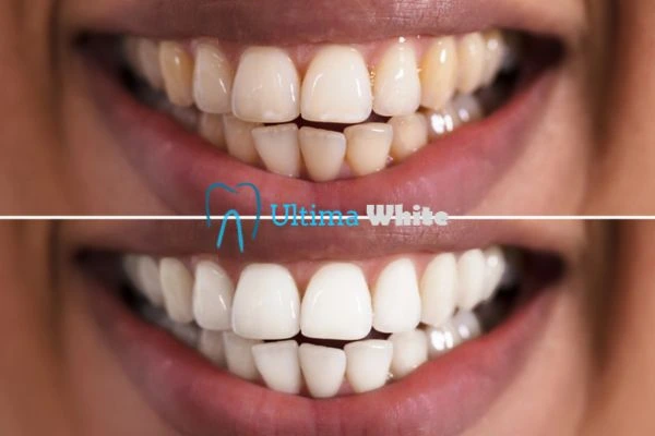 Long lasting results from Ultima White Scunthorpe